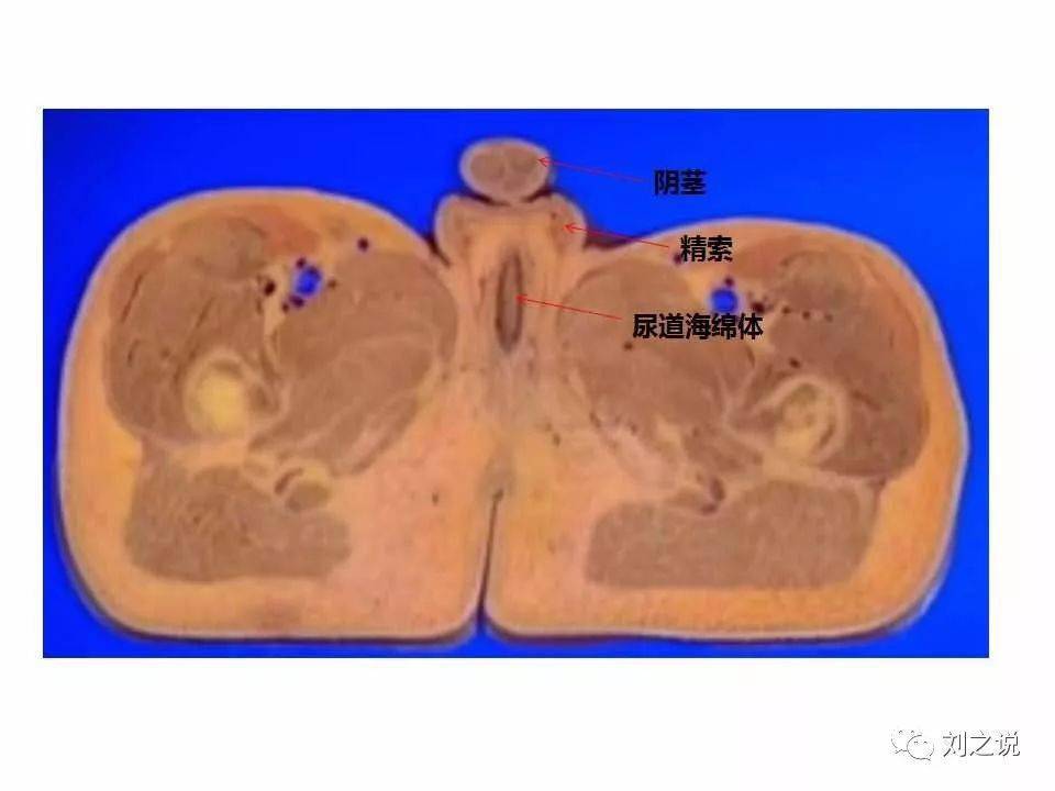 精索位置示意图CT图片