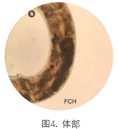 合并|一例分析 | 类风湿关节炎患者合并「钩虫感染」