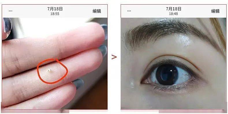 眼睛长了脂肪粒到底挤不挤?一分钟教你处理它的正确姿势!