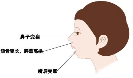 上颚高拱图片图片