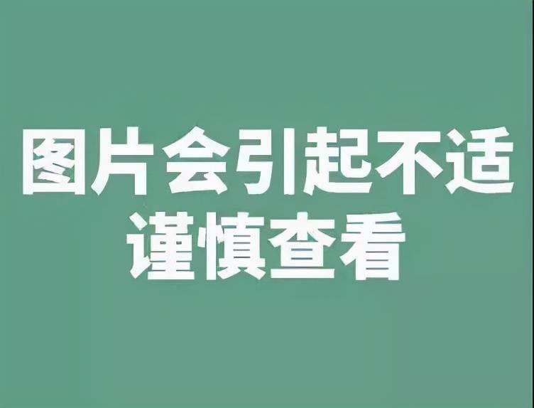 內鏡下痔套扎治療1針對內痔,我們可以採用內鏡下的微創治療,主要包括