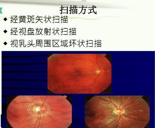 眼科oct检查图解红绿色图片