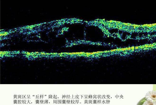 光学相干断层扫描(oct):清晰的显示眼后段主要是黄斑和视乳头的形态