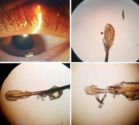 睑缘炎螨虫图片