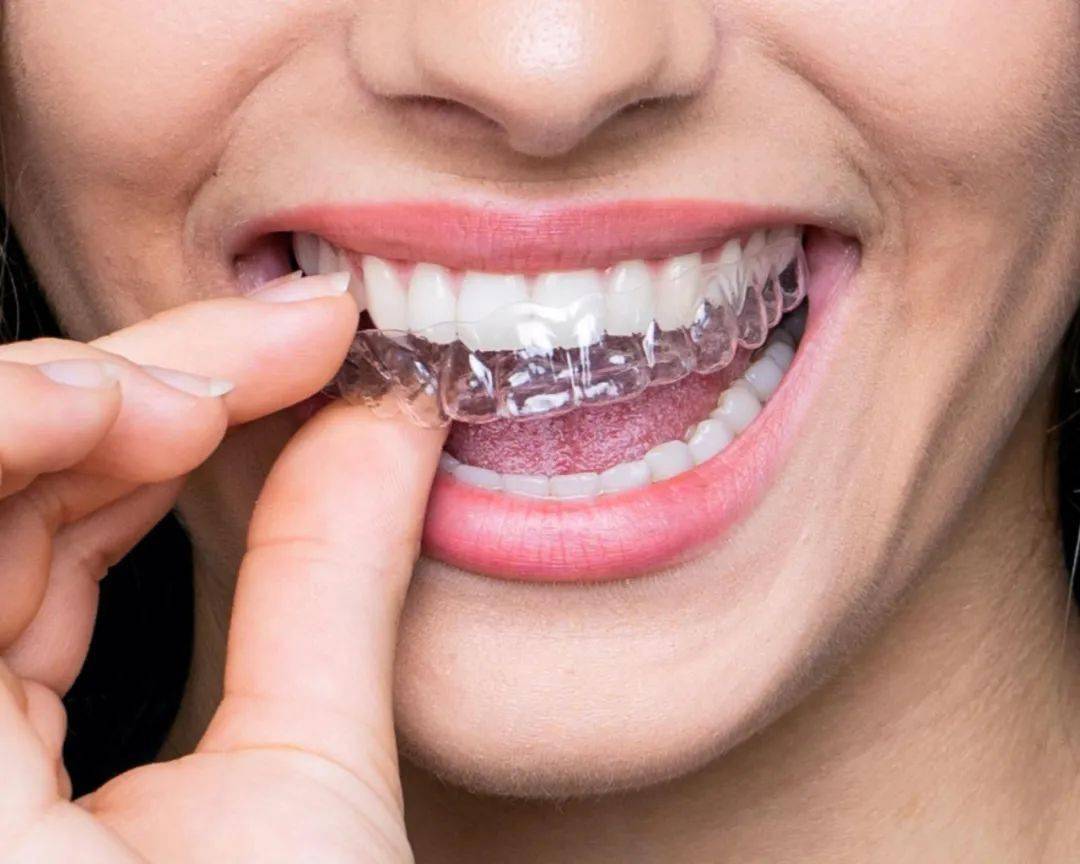 牙套保持器要戴多久由钢丝充胶制作而成,有点像俗称的活动假牙
