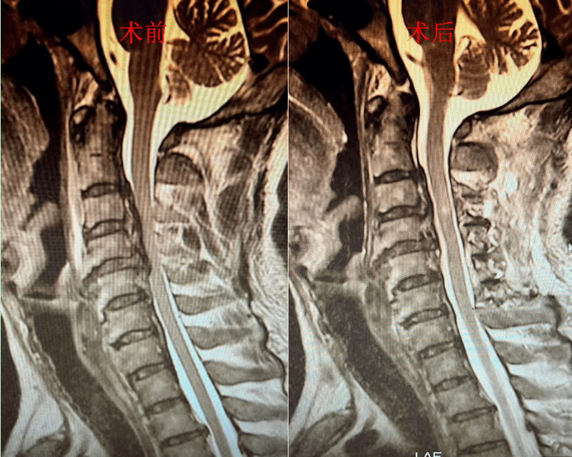 45岁男子摔瘫了,原因竟然是韧带变"骨头"_董先生_颈椎_脊髓