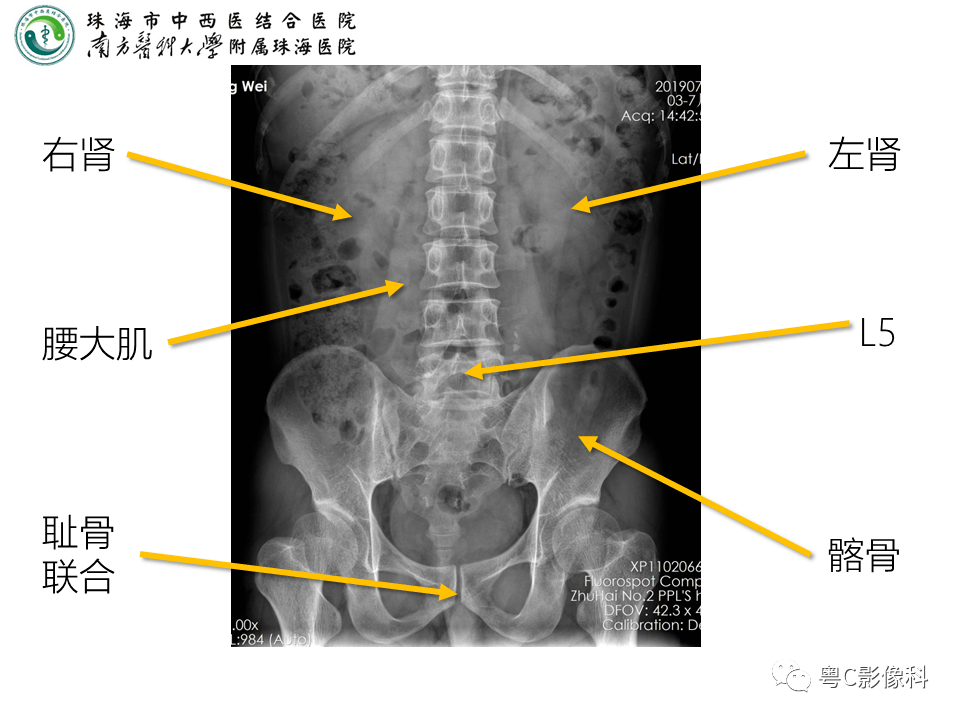 腹平片x线摄影及常见急腹症的诊断_全网_影像_解剖图