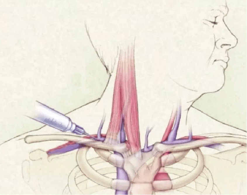 实战技术 | 锁骨上入路---锁骨下静脉穿刺术_血管_导管_针尖