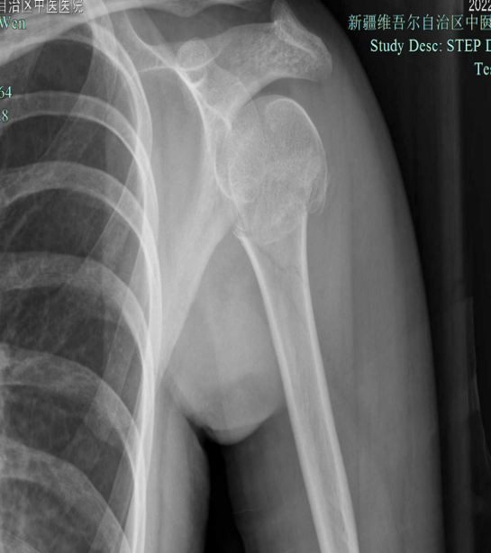 德胜|【医文医话】骨一科：夹板固定、中药外敷——肱骨近端骨折也有保守疗法
