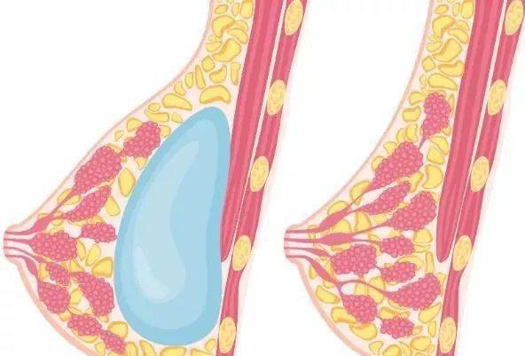 女人的胸,真的能「摸摸大」?_乳房_乳腺_脂肪