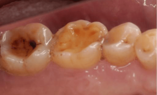 酸牙倒牙别紧张牙医带你认识牙本质敏感症