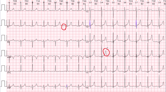 心电图如何判读用万能5步法就够了