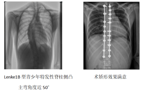 青少年|青少年需警惕“剃刀背” 专家提醒早发现早治疗