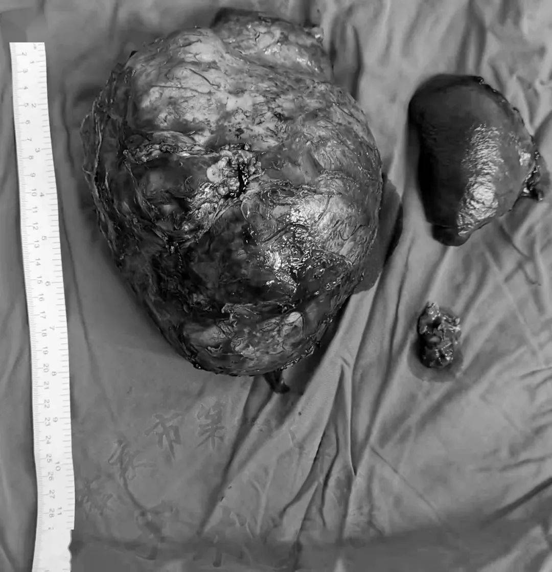 男子腰部乏力检查竟患癌肇庆一院成功切除巨型腹膜后肿瘤助其重获新生