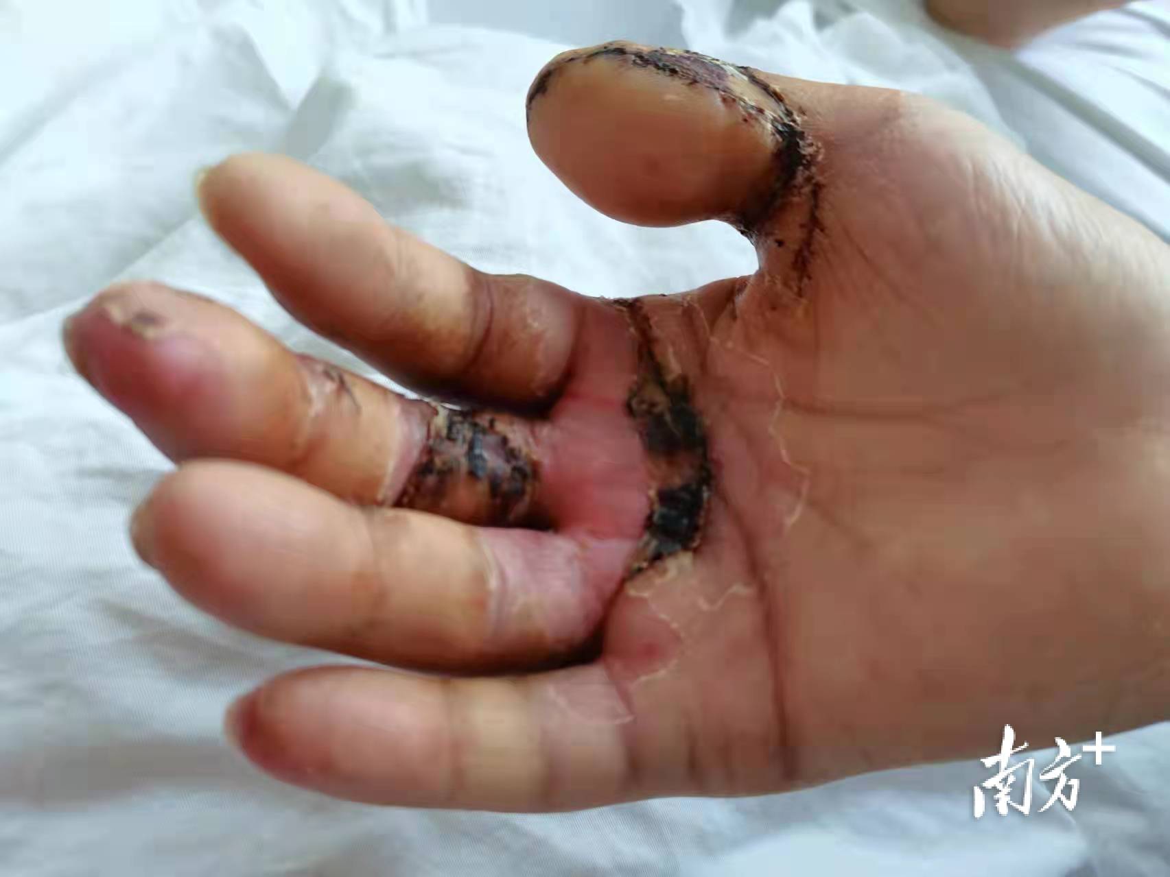 珠海一男子成功实现断指再造_拇指_手术_右手