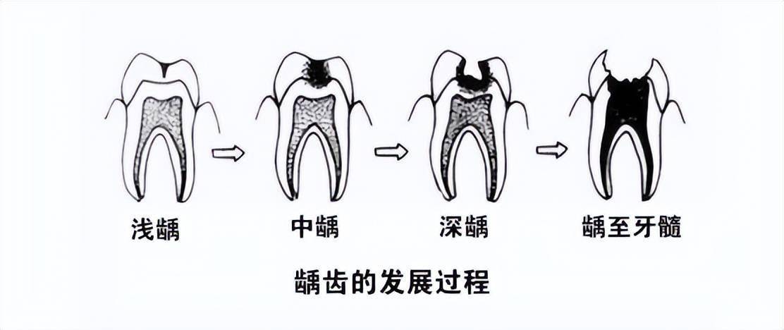 當牙齒僅有齲洞,而沒有累及牙髓時,可去除齲洞內被破壞的牙齒結構