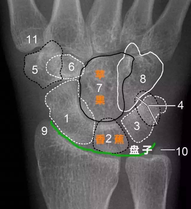 頭狀骨 8.鉤骨 9.橈骨莖突 10.尺骨莖突 11.
