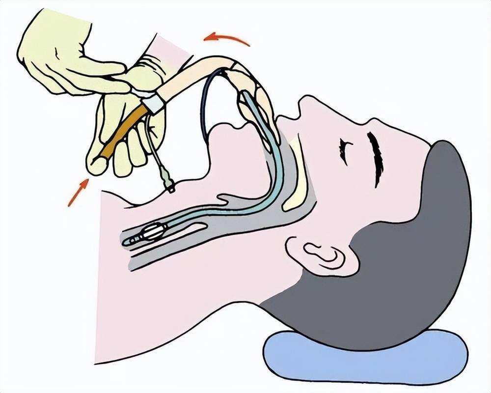 气管插管图片卡通图片