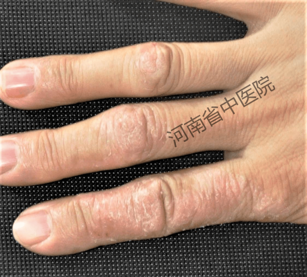 手指皮肤病图片图片