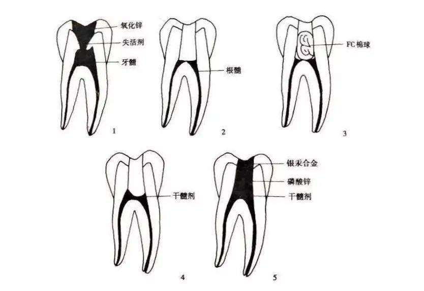 干髓糊剂的临床应用