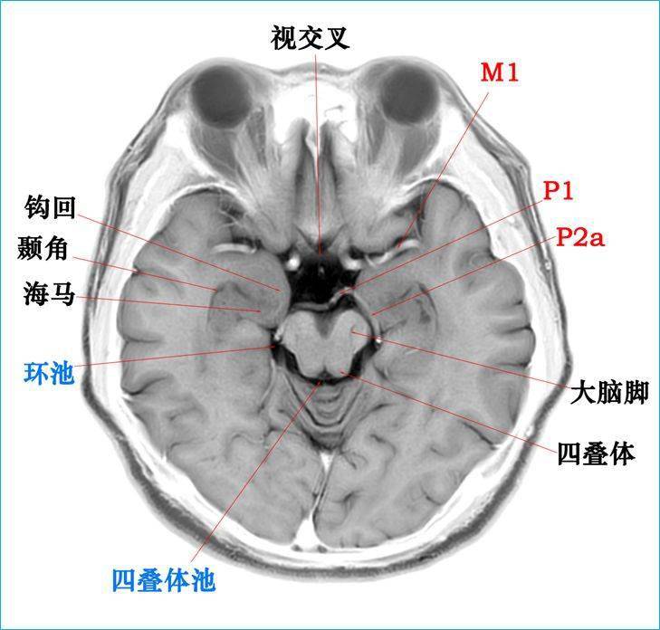 收藏| 高清顱腦斷層解剖圖譜_全網_影像_系統