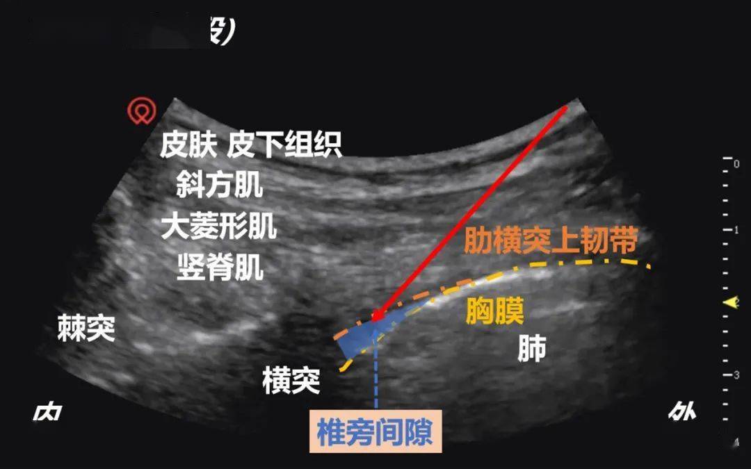 胸椎旁神经阻滞图片