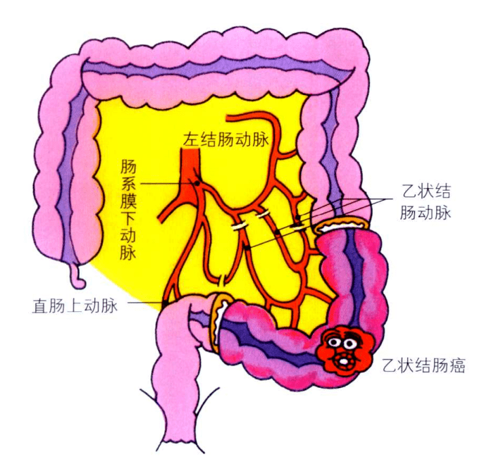 图说结肠癌我讲您来听