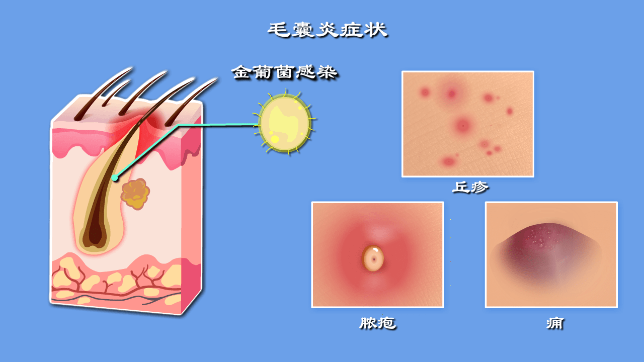 女性阴囊上长疙瘩图片