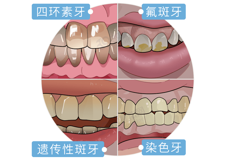 真正有效的是這3種_牙釉質_過氧化物_激光