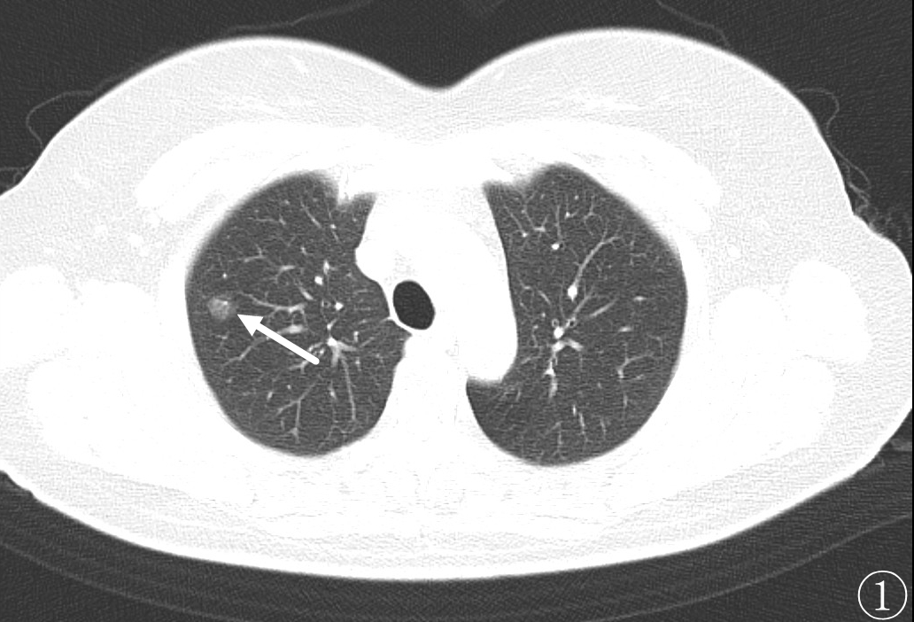 针芯化结厦门市中医院首例ct引导下肺结节微波消融