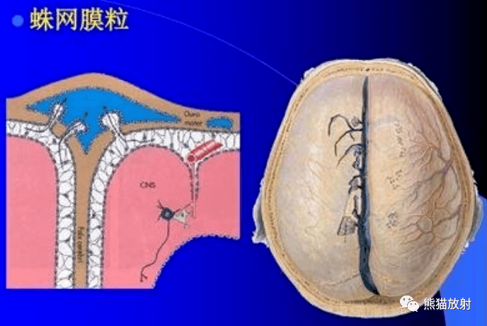 治疗:硬脑膜静脉窦血栓形成;硬脑膜动静脉瘘;蛛网膜囊肿;表皮样瘤