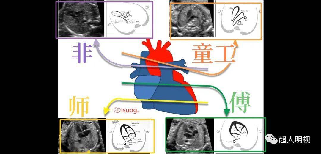 胎儿心脏6个重要横切面
