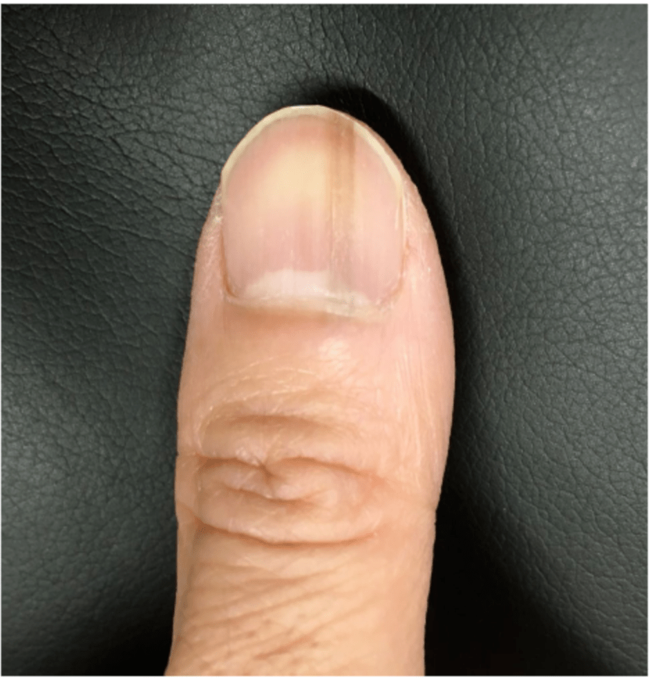 精选编译脊柱外科医师指甲纵向黑甲病和湿疹