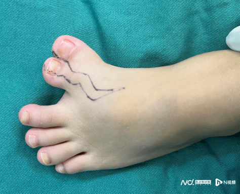 需要巧妙设计两次手术让患儿恢复正常足形考虑到孩子的身体承受能力