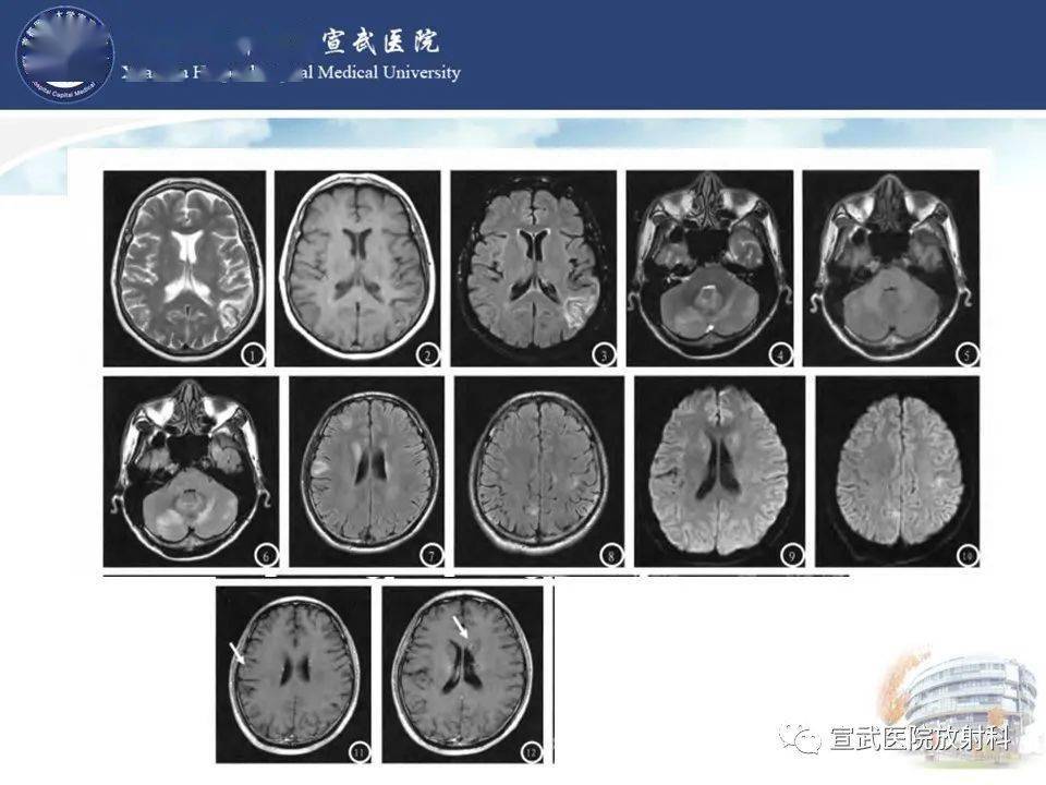 进行性多灶性白质脑病影像表现