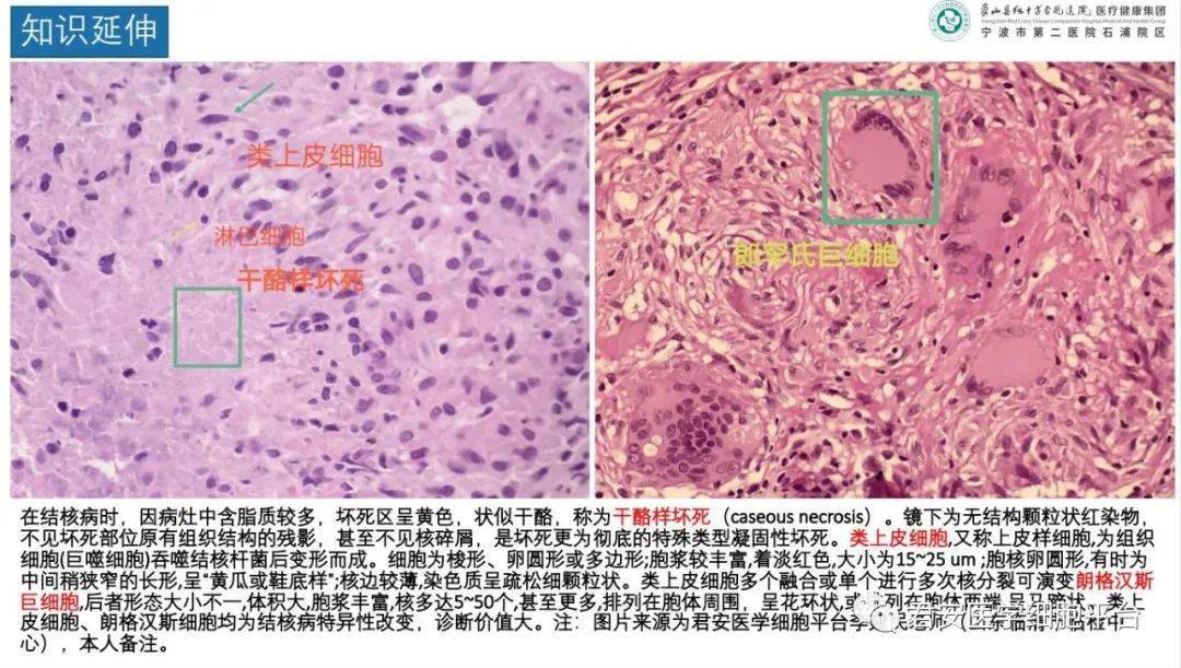 四例淋巴结转移癌案例分享_检验_细胞_形态学