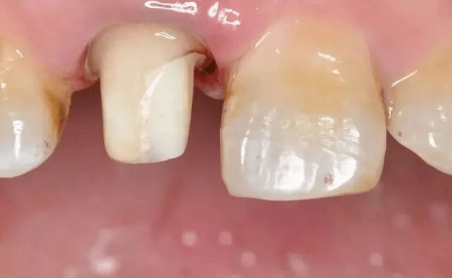 6,如果是碰到牙龈萎缩的情况,尽可能备在釉牙骨质界上.