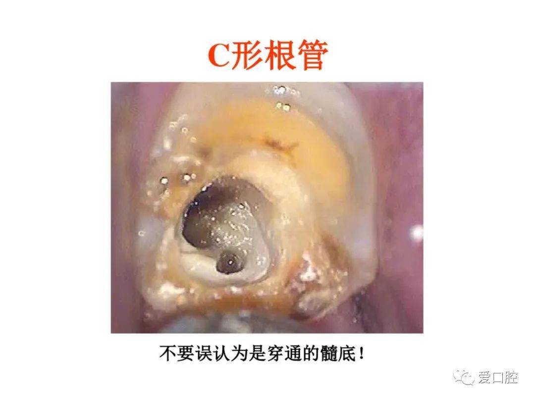 乳牙开髓洞型图片