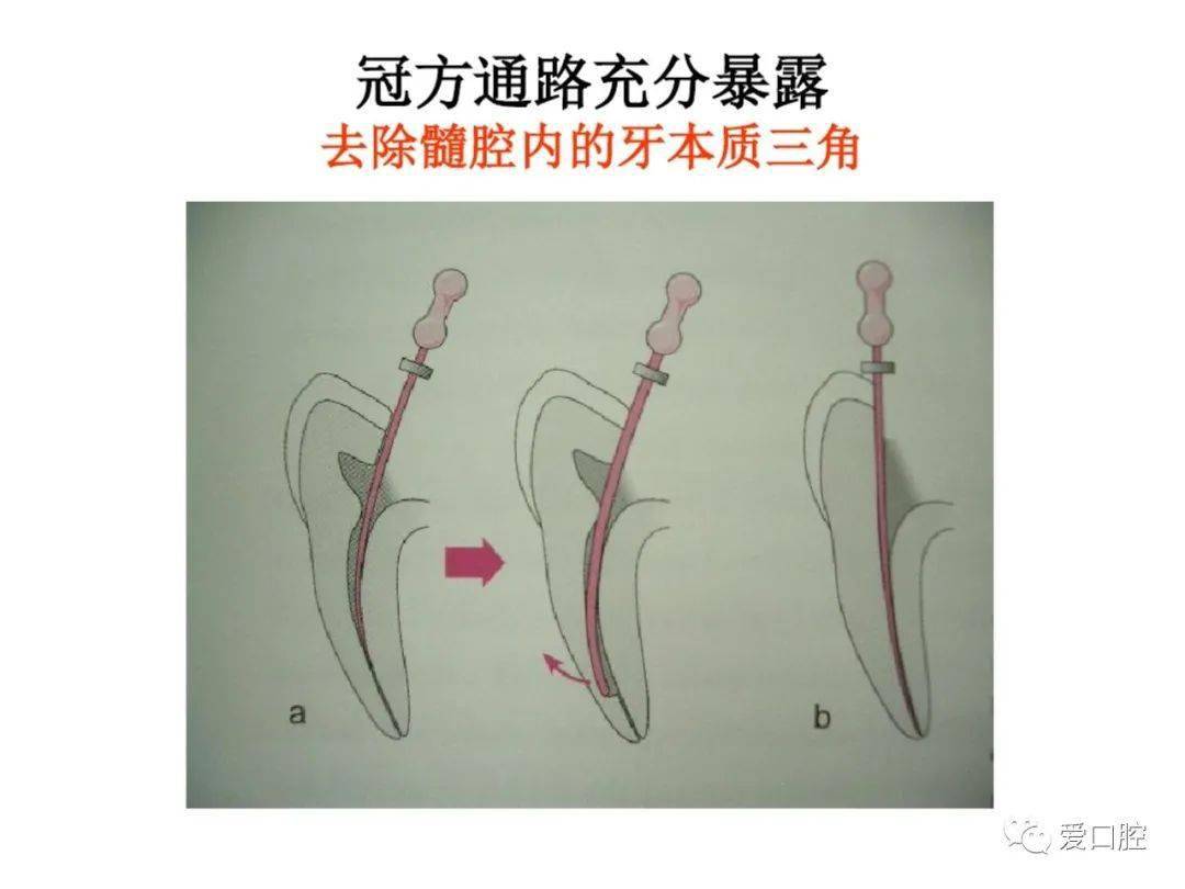 乳磨牙开髓部位图片