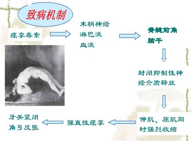 医者解读▏手被门夹了一下就得了破伤风
