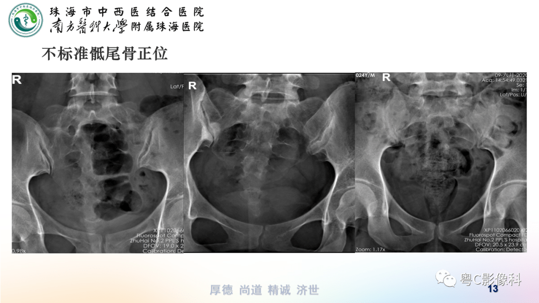 骶椎侧位x线解剖图图片