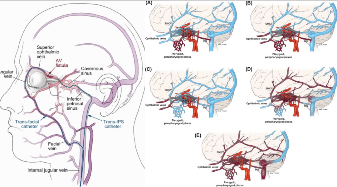 神介骑士论坛第45期精华回顾海绵窦区硬脑膜动静脉瘘的治疗策略
