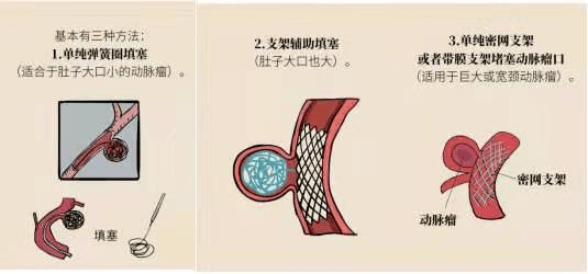 血管内介入弹簧圈栓塞颅内动脉瘤(微创手术):治疗难点在于该患者的