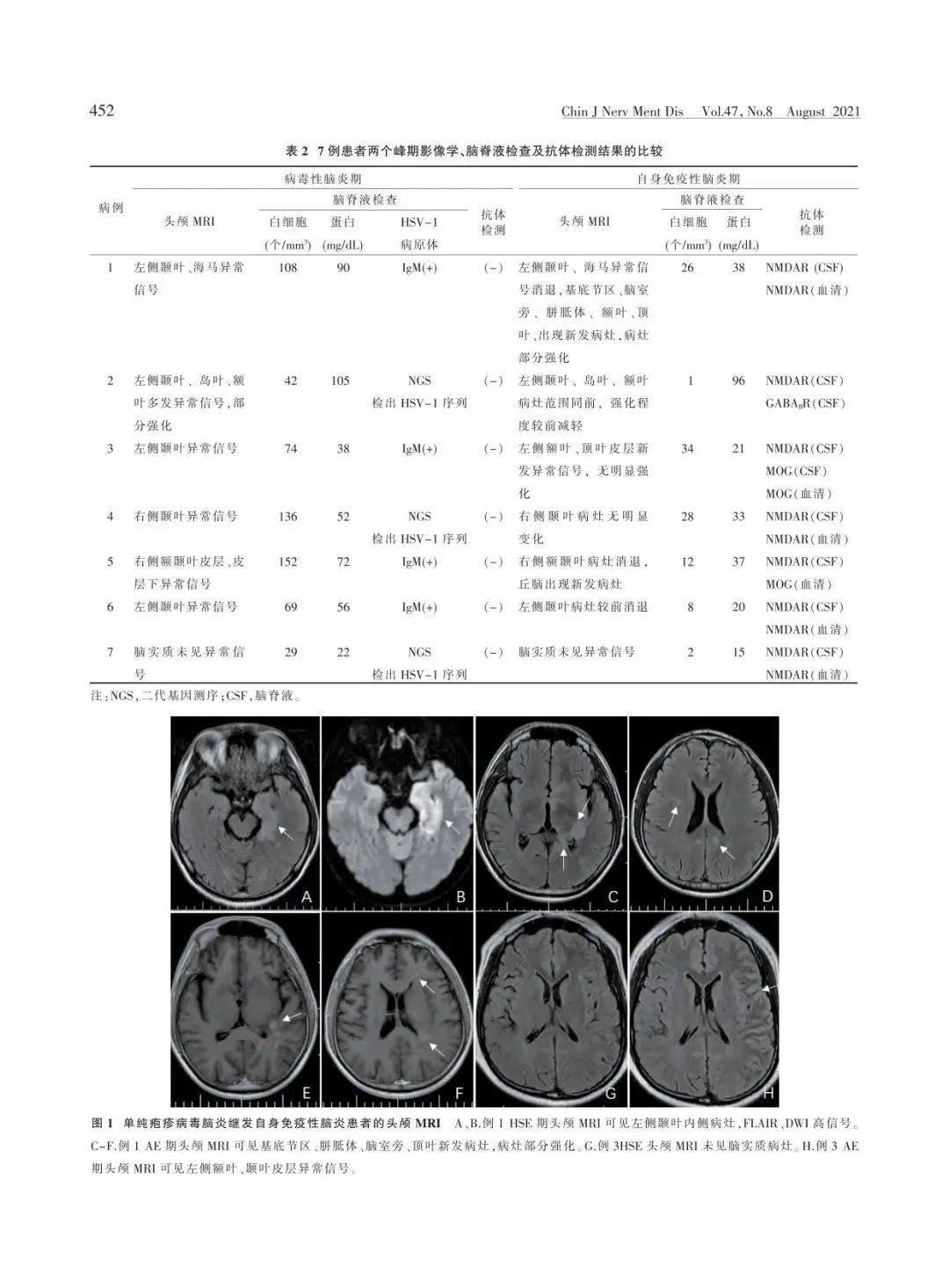 论著|呈典型双峰脑炎表型的单纯疱疹病毒脑炎继发自身免疫性脑炎_抗体