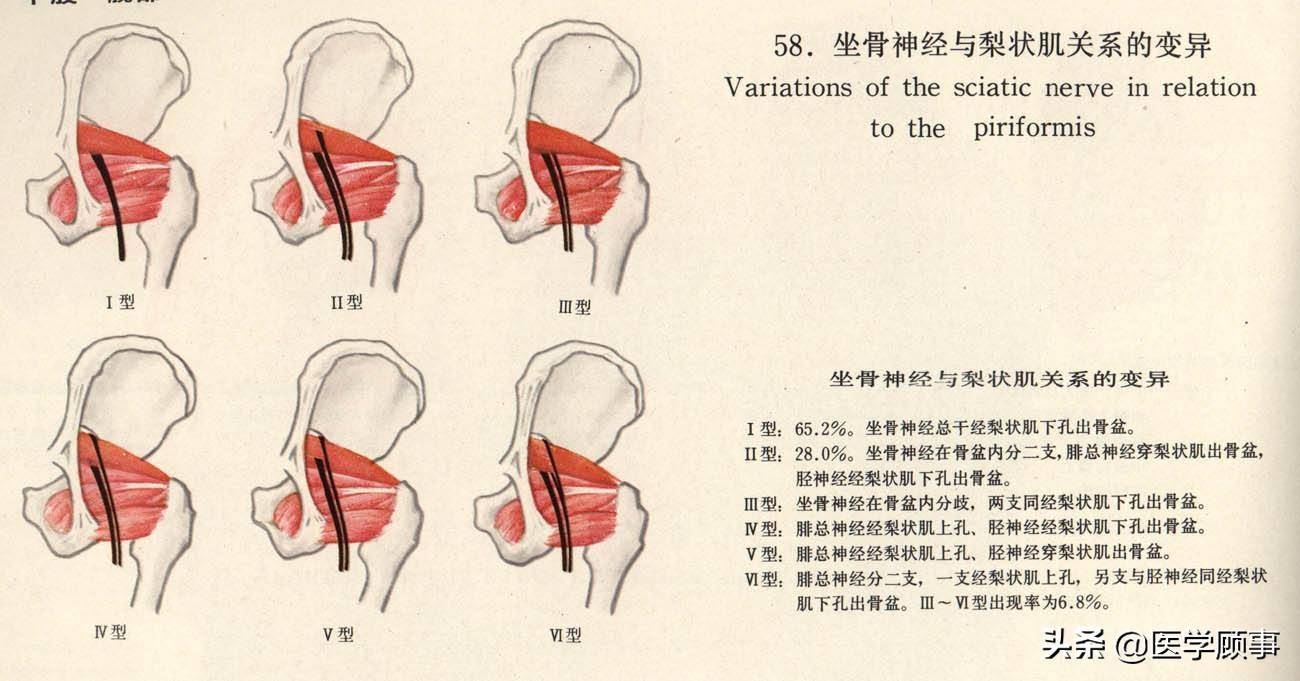 (九)股外侧皮神经卡压综合征:股外侧皮神经通过髂前上棘处,在髂前上棘