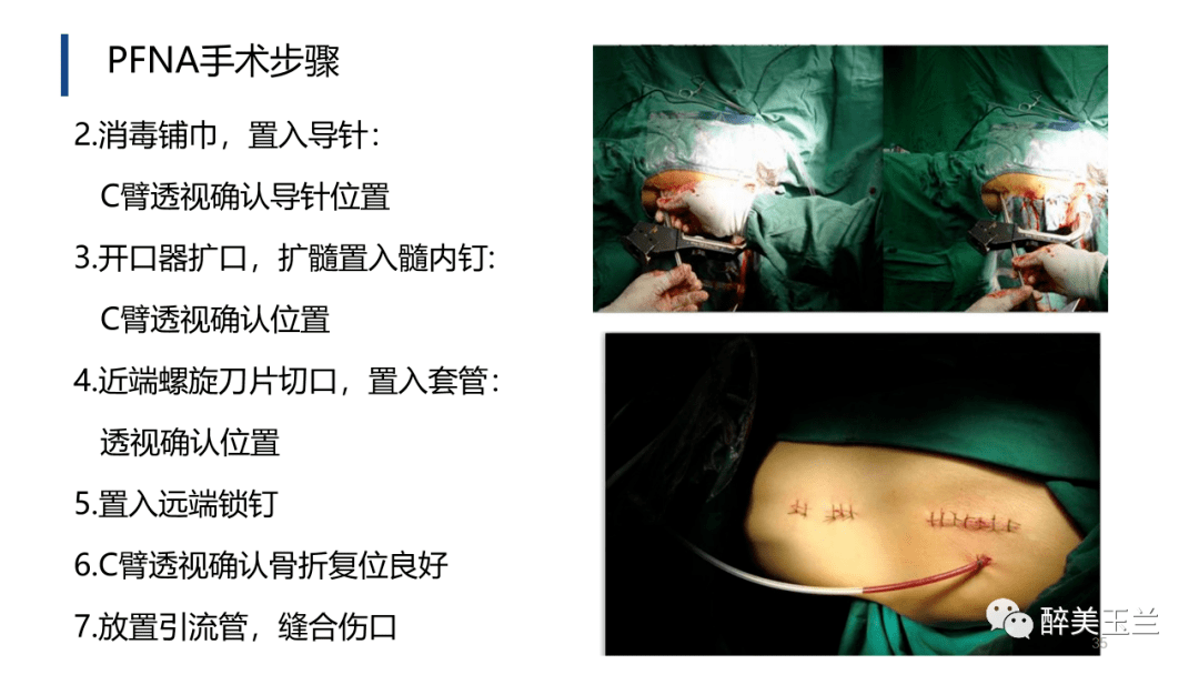 病例讨论老年心衰患者pfna内固定术的麻醉管理