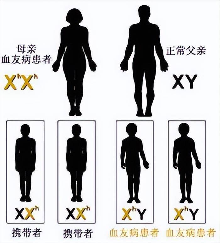 关爱玻璃人,远离玻璃心_患者_关节炎_遗传性