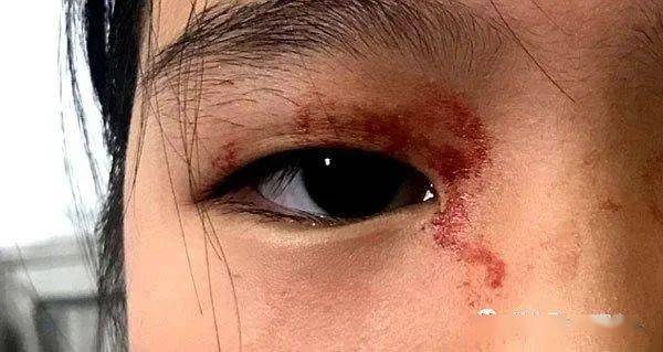 7岁女童染怪病全身恐怖渗血照片曝光眼睛手指冒血水