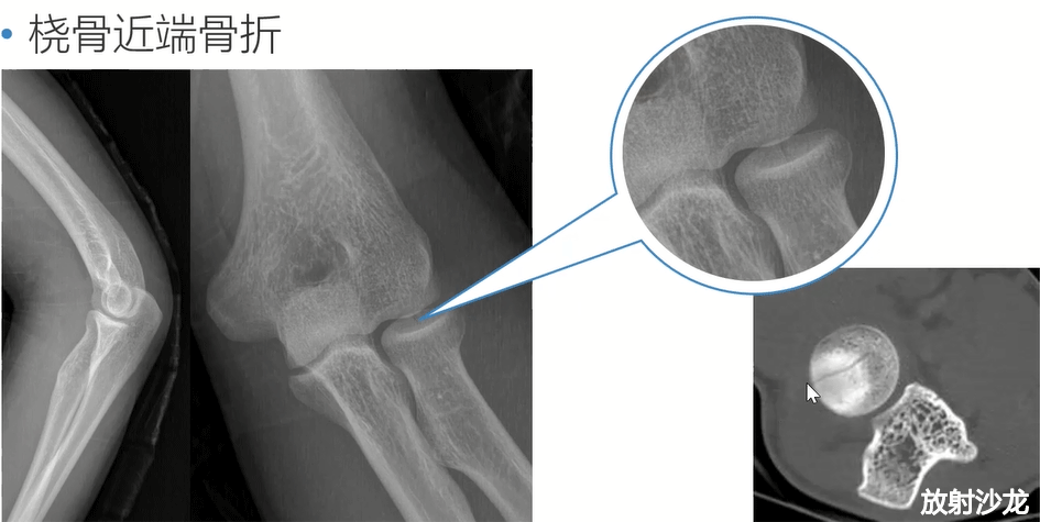 高清圖解肘關節隱性創傷骨折這些影像診斷要點不可忽視