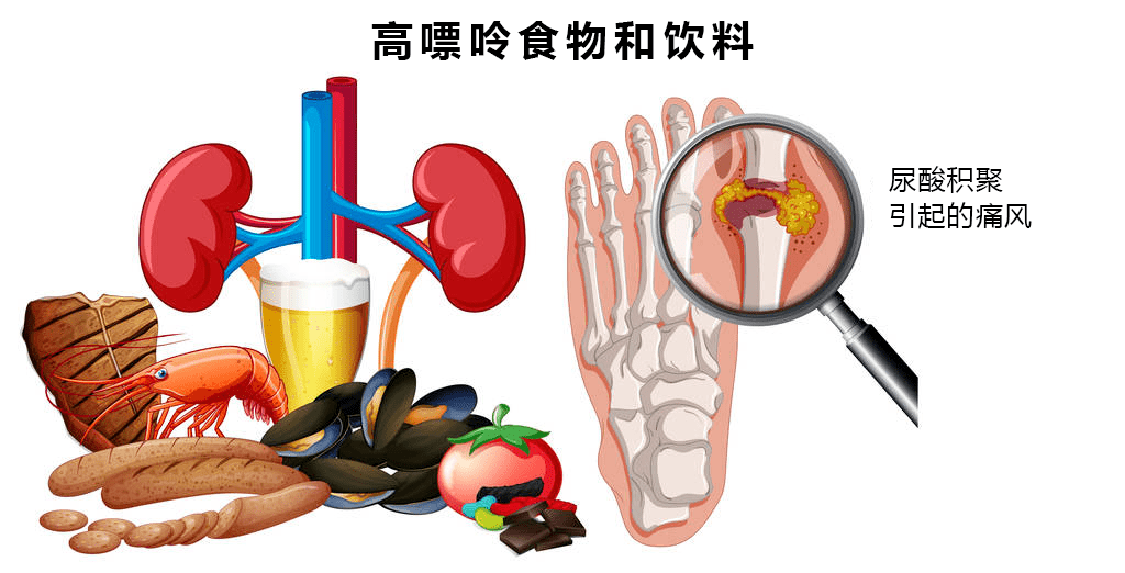 高尿酸血癥發病率高達133可以這樣預防